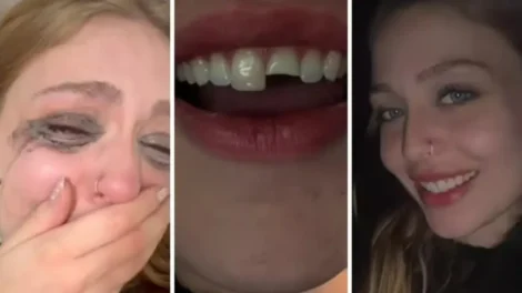 Jovem quebra dente na balada no PR, cola na madrugada e volta para a festa
