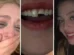 Jovem quebra dente na balada no PR, cola na madrugada e volta para a festa