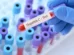 Mortalidade por hepatite viral atinge 1 a cada 5 pacientes com 80 anos no SUS
