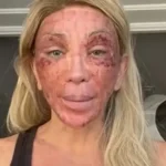 'Não consigo nem rir', diz Maya Massafera mostra rosto inchado após peeling e ironiza reação: 'Não consigo nem rir'