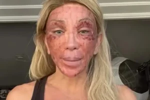 'Não consigo nem rir', diz Maya Massafera mostra rosto inchado após peeling e ironiza reação: 'Não consigo nem rir'