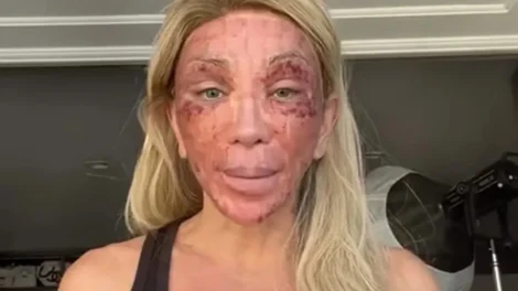 'Não consigo nem rir', diz Maya Massafera mostra rosto inchado após peeling e ironiza reação: 'Não consigo nem rir'