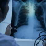 Entenda quando uma infecção respiratória pode evoluir para pneumonia