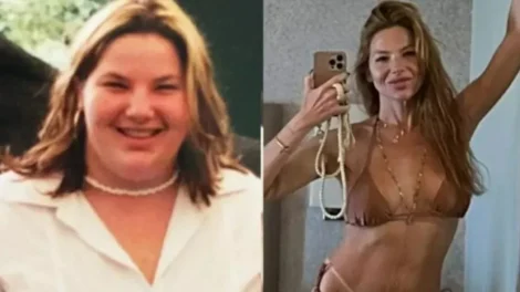 Irreconhecível: Repórter da Globo perde 70kg e 8 dentes após bariátrica
