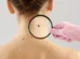 Moderna e Merck anunciam sucesso de vacina experimental com mRNA contra recidiva do melanoma