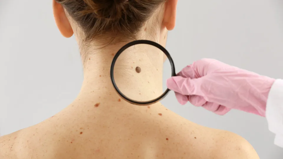 Moderna e Merck anunciam sucesso de vacina experimental com mRNA contra recidiva do melanoma