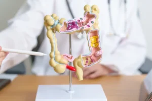 Pacientes com câncer colorretal têm medicamento aprovado pela Anvisa