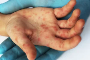 Quão perigoso é o sarampo? Sintomas para ficar de olho e como se proteger