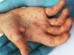 Quão perigoso é o sarampo? Sintomas para ficar de olho e como se proteger
