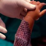 Brasil terá fábrica de pele de tilápia para tratar queimaduras