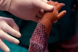 Brasil terá fábrica de pele de tilápia para tratar queimaduras