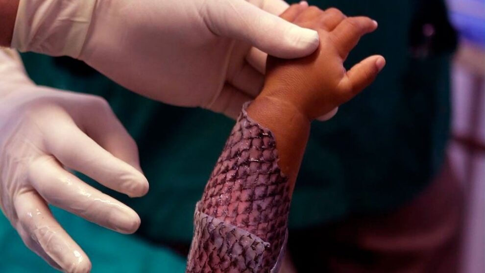 Brasil terá fábrica de pele de tilápia para tratar queimaduras