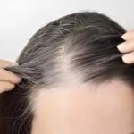 Canetas emagrecedoras podem provocar queda de cabelo, mas perda rápida de peso é apontada como principal causa