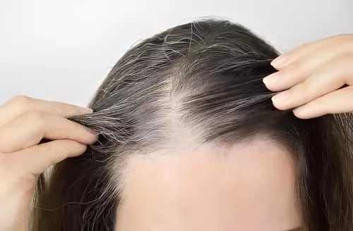 Canetas emagrecedoras podem provocar queda de cabelo, mas perda rápida de peso é apontada como principal causa