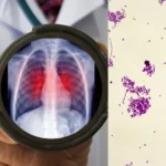 Peste pneumônica: o que é, os riscos e como se transmite esta infecção