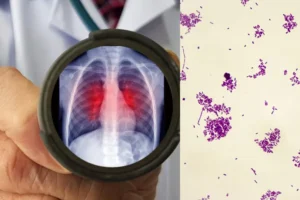 Peste pneumônica: o que é, os riscos e como se transmite esta infecção