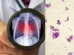 Peste pneumônica: o que é, os riscos e como se transmite esta infecção