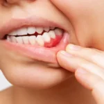 Retração gengival: por que a gengiva se afasta dos dentes e como prevenir