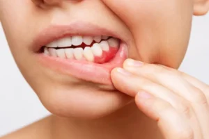 Retração gengival: por que a gengiva se afasta dos dentes e como prevenir