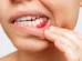 Retração gengival: por que a gengiva se afasta dos dentes e como prevenir