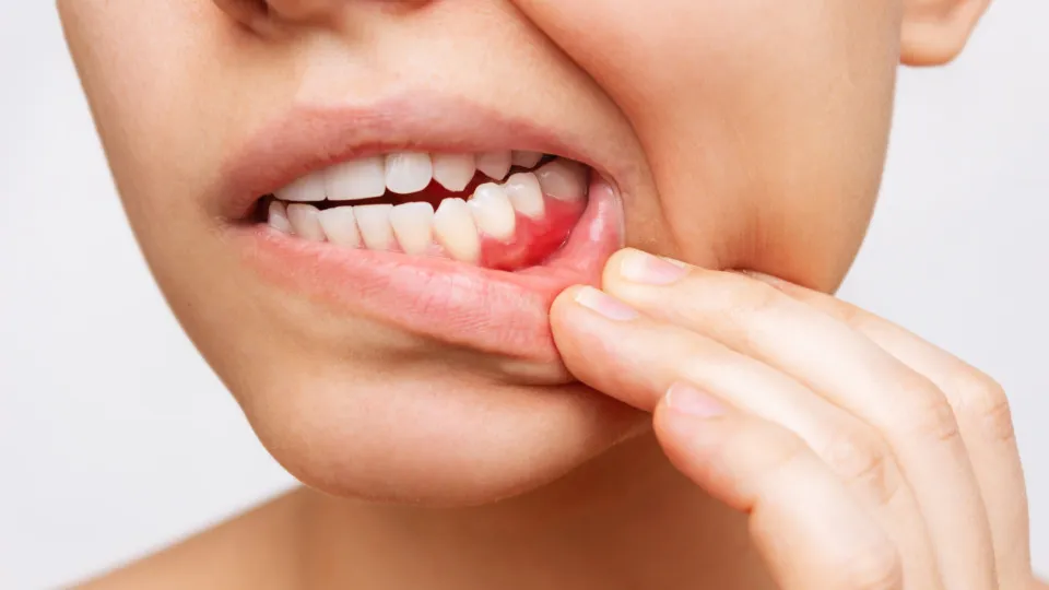 Retração gengival: por que a gengiva se afasta dos dentes e como prevenir